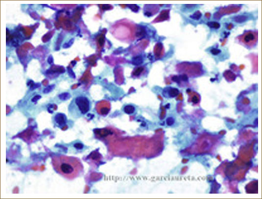 METÁSTASIS DE CARCINOMA ESCAMOSO BIEN DIFERENCIADO QUERATINIZANTE EN GANGLIO LINFÁTICO