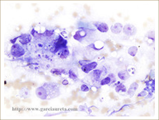 CARCINOMA METASTÁSICO DE PRÓSTATA