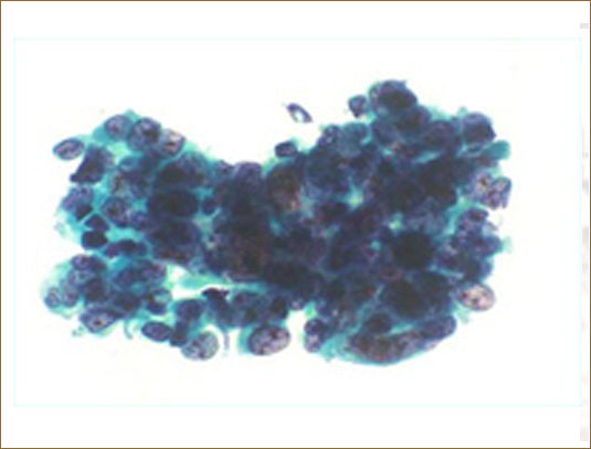 CARCINOMA ANAPLÁSICO DE CÉLULA PEQUEÑA