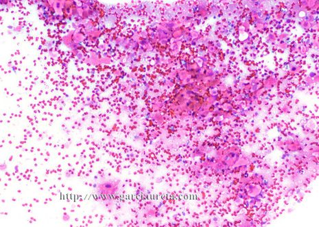 Aspecto general de un carcinoma escamoso bien diferenciado en una muestra de punción aspiración de un ganglio linfático.