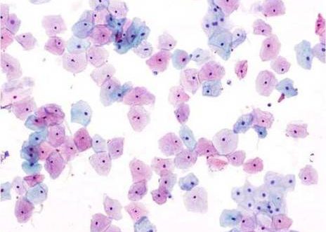 Células escamosas superficiales e intermedias con normal morfología, descamadas de un epitelio escamoso no queratinizante.