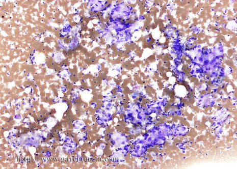 Células tumorales de metástasis de Adencarcinoma de próstata en muestra obtenida por punción aspiración.