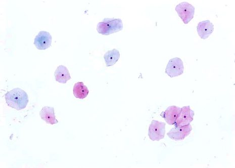 Células superficiales escamosas de una muestra cervical con abundante citoplasma y núcleo picnótico.