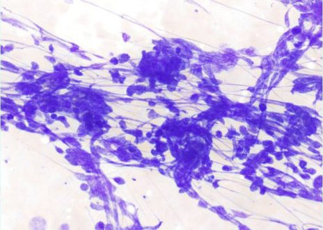 Grupo poco cohesivo de células pleomórficas con escaso citoplasma. Artefactos de aplastamiento
