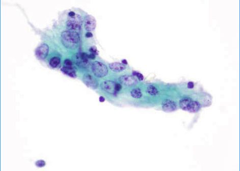 Fragmento plano de células glandulares con pleomorfismo moderado.