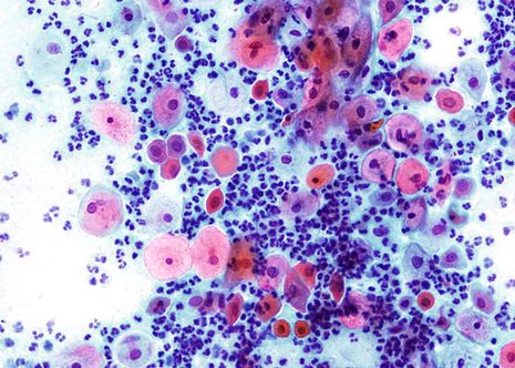 Placa de células parabasales en una muestra atrófica. El citoplasma de algunas células ha degenerado presentando algunos nucleos libres en el extendido.