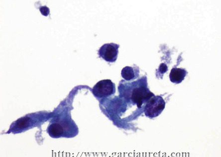 Células malignas pleomorficas con núcleo hipercromático excéntrico y citoplasma denso.