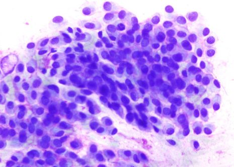 Células epiteliales monótonas con núcleo redondeado o ligeramente oval conteniendo cromatina granular fina y nucleolo pequeño.
