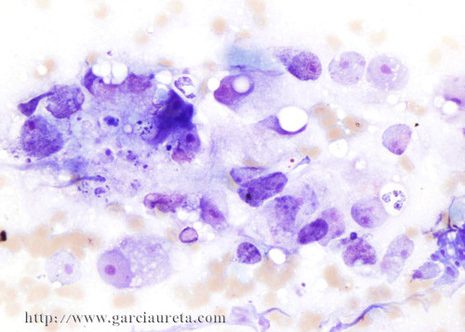 Células tumorales con citoplasma pálido y mal definido.
