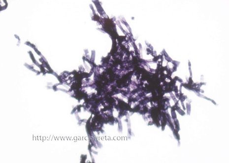 Las hifas de Aspergillus comparadas con la de Cándida son más gruesas y muestran septación y bifurcación en ángulos de 45º. Tinción Grocott