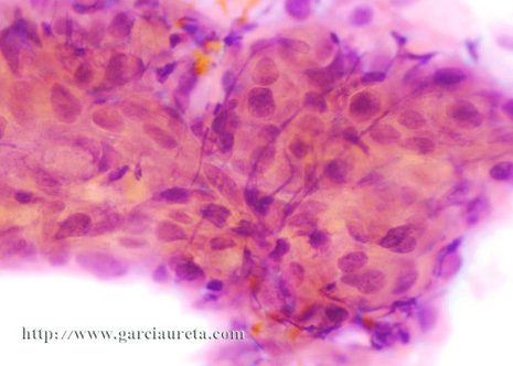 Agregado de células malignas con bordes celulares imprecisos con núcleos irregulares hipercromáticos.