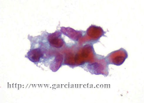 Células tumorales con contornos nucleares irregulares.