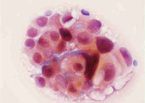 Acúmulo de células uroteliales malignas con vacuolización citoplasmática.