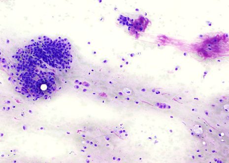 Estroma fibrilar mixoide que se identifica facilmente con MGG.