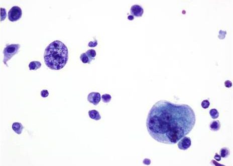 Orina de un caso de carcinoma in situ de vejiga. Células anormales grandes con núcleo irregular. La cromatina es grumosa y la relación núcleo citoplasma alta.
