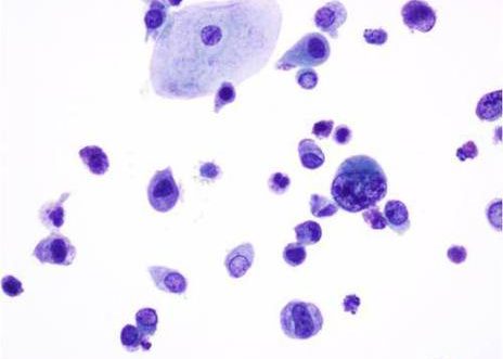 Células uroteliales anormales aisladas con núcleo agrandado hipercromático correspondientes a un Carcinoma in situ de vejiga.