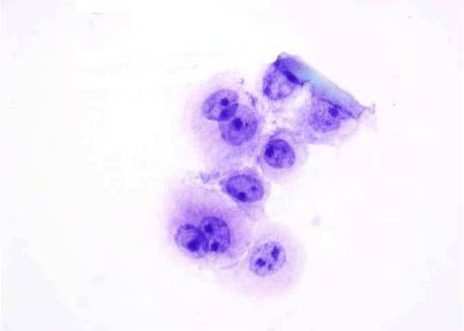 Orina: Carcinoma urotelial de alto grado. El núcleo de las células malignas está agrandado y la membrana nuclear presenta engrosamiento focal. Algunos de los núcleos presentan múltiples nucléolos prominentes.
