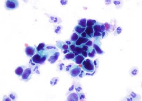 Orina: Carcinoma urotelial de alto grado. Las células uroteliales malignas varían en tamaño y forma y presentan grados variables de degeneración.