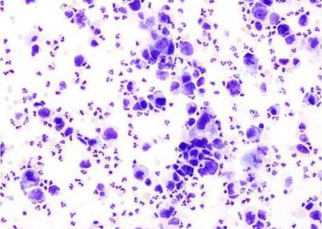 Carcinoma pobremente diferenciado (grado III) de vejiga. Núcleos agrandados con prominente nucléolo.