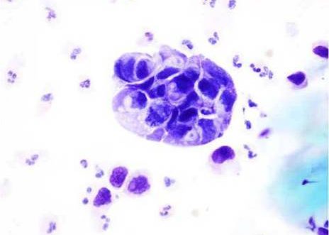 Orina de un caso de carcinoma pobremente diferenciado de vejiga. Acúmulo de células con núcleos grandes irregulares y alta relación núcleo citoplasma.