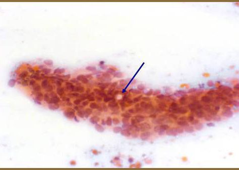 Pap: Presencia de luces intracitoplasmáticas.