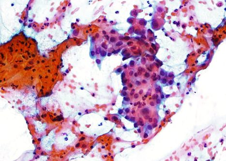 Células de morfología escamosa inmadura con alta relación núcleo citoplasma. Núcleo grande y cromatina granular fina.