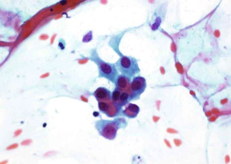 Céluals de metaplasia escamosa madura con discreta atipia con núcleo irregular algo agrandado.