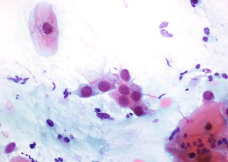 Células aisladas y en láminas de metaplasia escamosa.