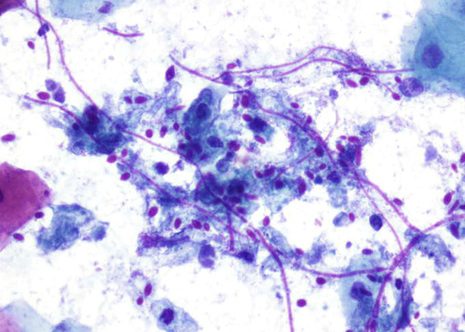 Candida Albicans. Filamantos alargados septados eosinófilos y esporas.