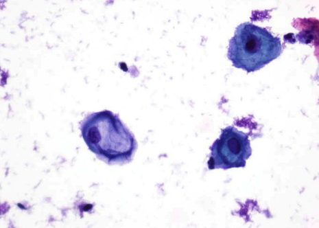 Coilocitos con amplio halo perinuclear y núcleo con agrandamiento variable Koilocytes with well-defined clearing of cytoplasm around the nuclei and variable nuclear enlargement. Coilocitos con amplo halo perinuclear e núcleo con agrandamento variabel.