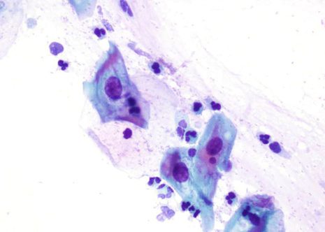 L-SIL. Agrandamiento nuclear y patrón cromatínico anormal. El aclaramiento citoplasmático probablemente indican infección por HPV.