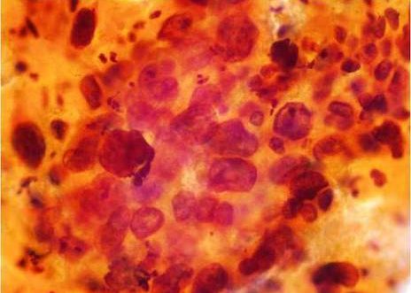 Carcinoma Escamoso. Acúmulos de celulas malignas sangre y restos necróticos