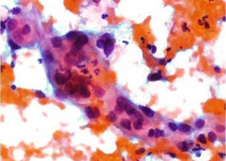 Carcinoma Escamoso. Nucleos con variable forma y tamaño con patron cromatinico anormal.