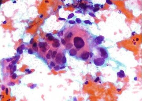 Carcinoma Escamoso.Hipercromasia y pleomorfismo. Cromatina grumosa distribuida irregularmente