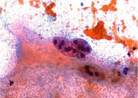 Carcinoma Escamoso.Hipercromasia y pleomorfismo. Cromatina grumosa distribuida irregularmente