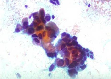 Adenocarcinoma Endocervical. Celulas endocervicales atípicas, con marcada variación en el tamaño celular