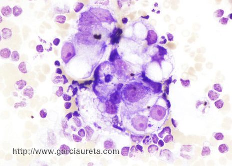 Células de tamaño intermedio con moderado pleomorfismo y nucléolo prominente