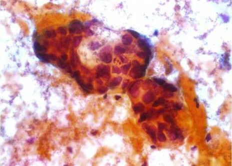 Adenocarcinoma Endocervical. Acumulo de células endocervicales con marcada atipia