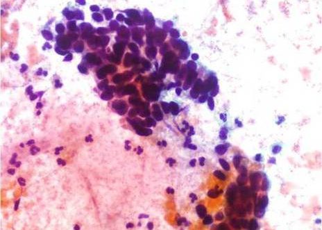 Adenocarcinoma Endocervical. Celulas indiferenciadas sin evidencia de caracteres citoplasmáticos y nucleos hipercromaticos marcadamente anormales.