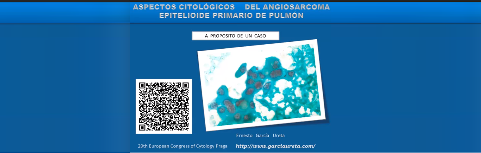 Angiosarcoma