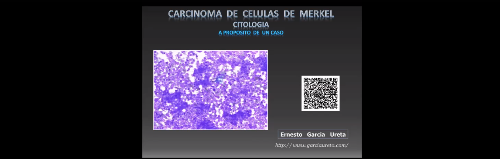 Carcinoma de células Merkel