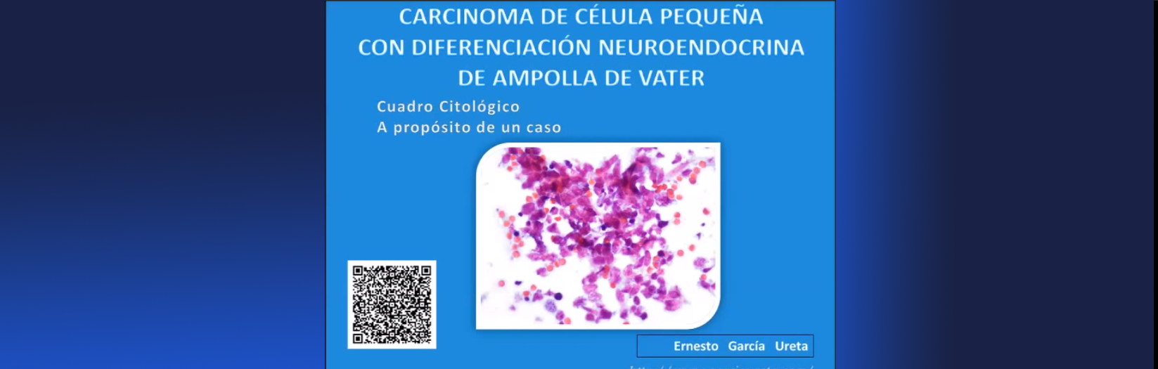 Carcinoide