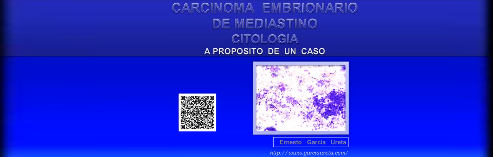 Carcinoma Embrionario