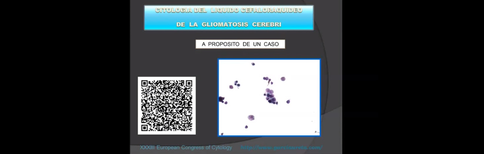 Gliomatosis Cerebri