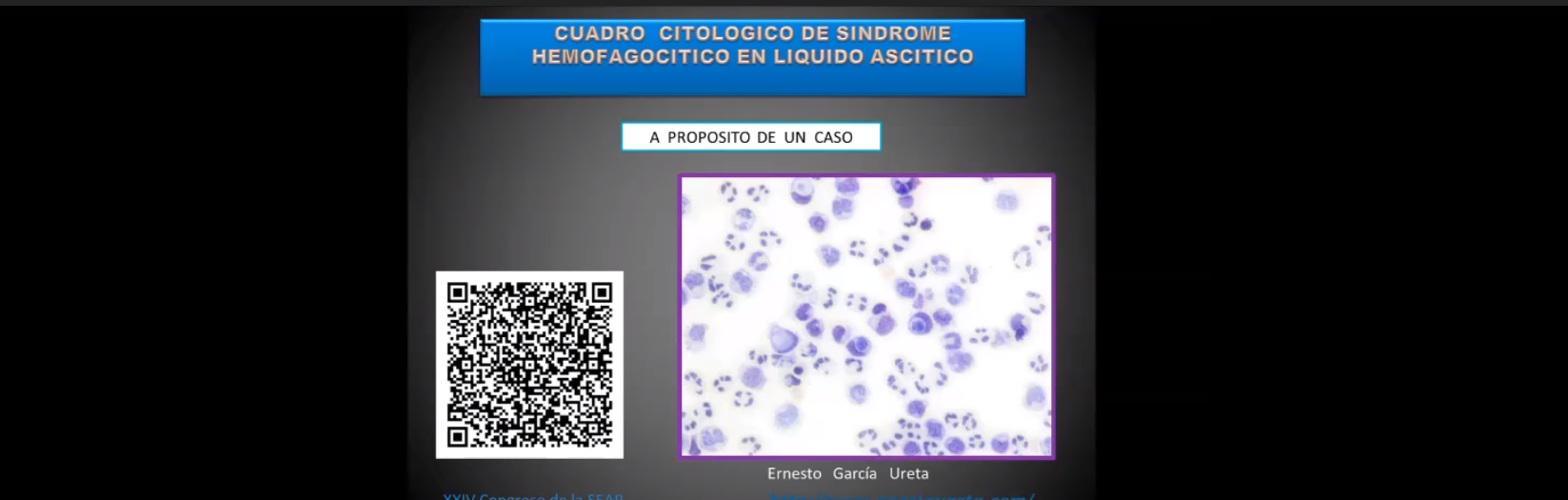 Hemofagocitosis