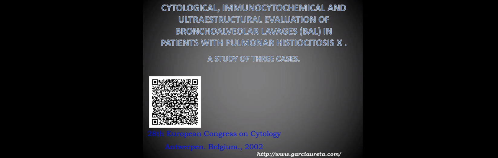 Histiocitosis X pulmonar