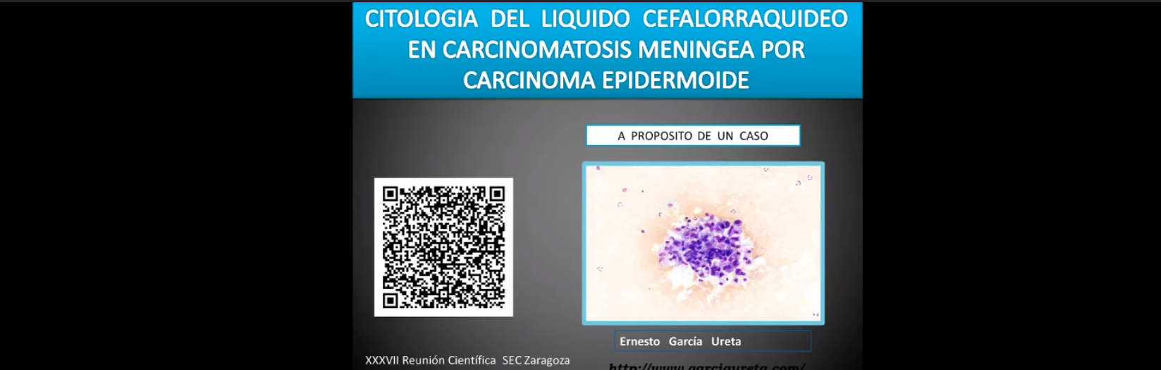 Meningitis carcinomatosa por carcinoma epidermoide