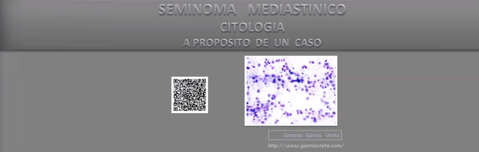 Seminoma