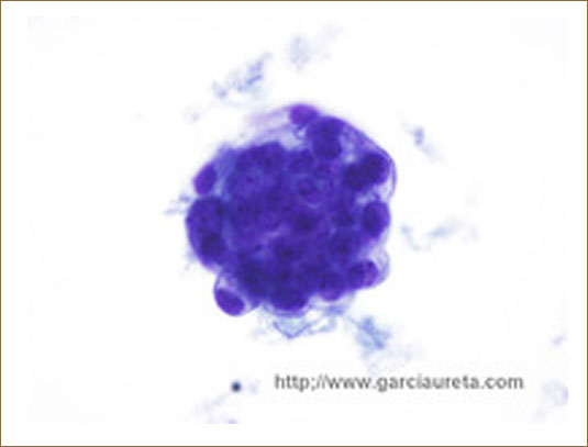 METASTATIC ADENOCARCINOMA OF STOMACH IN PLEURAL EFFUSION