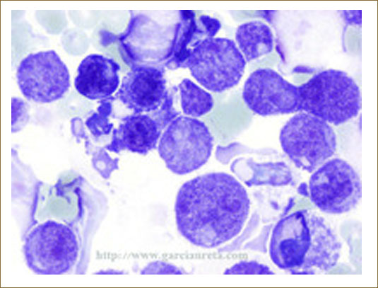 Pleural Effusion in a Patient with Lymphoma Malignant